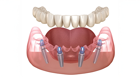 Illustration of a denture supported by four dental implants