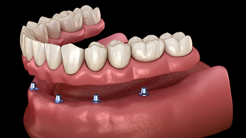 Illustration of an All on X implant denture being placed