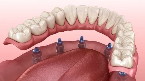 Illustration of six dental implants supporting a full denture