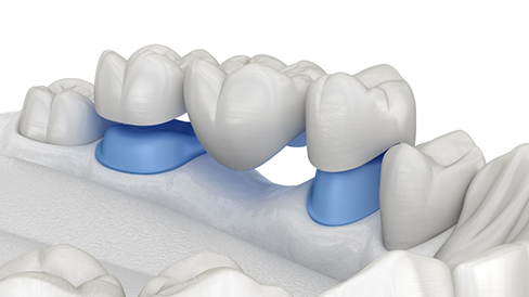 Illustration of a dental bridge replacing a missing tooth