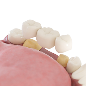 Dental bridge supported by two natural teeth