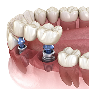 Dental bridge supported by two dental implants