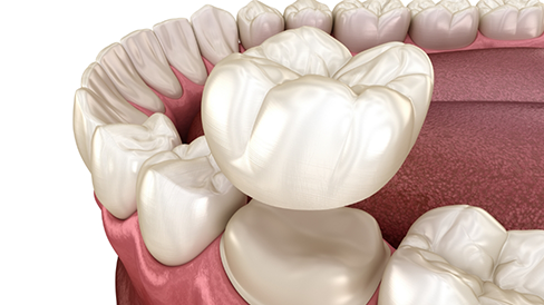 Illustrated dental crown being placed over a tooth
