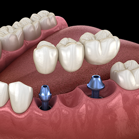 Illustrated dental bridge on two dental implants