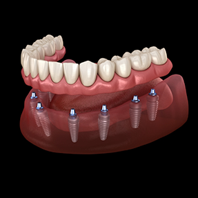 Illustrated denture on eight dental implants