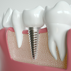 Illustration of a dental implant post in the lower jawbone