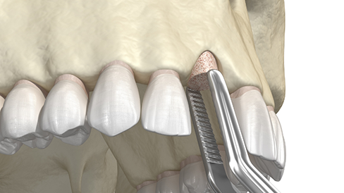 Illustration of bone material being grafted onto the upper jawbone