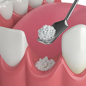 Illustration of grafting material being placed into the empty socket after a tooth extraction
