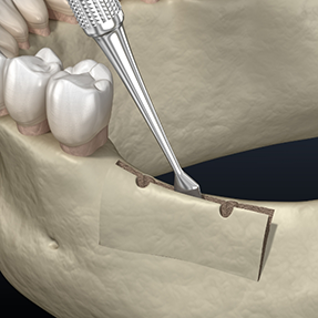 Illustration of the jawbone ridge being widened