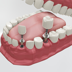Illustration of a mouth with two dental implants with crowns