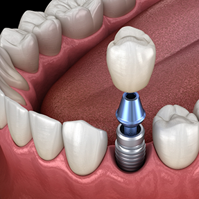 Illustrated dental crown on a dental implant