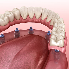 Illustration of an implant denture