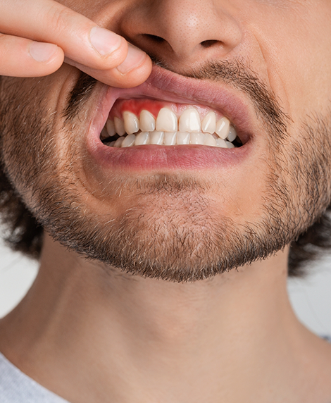 Man pointing to his red gums before getting gum disease treatment in Coral Springs