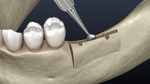 Illustration of the jawbone ridge being widened