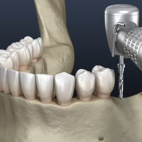 Illustration of a dental drill accessing the jawbone