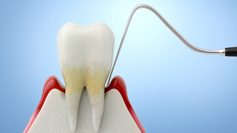 Illustration of a dental scaler measuring the pocket between tooth and gums