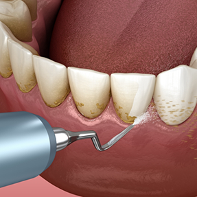 Illustration of a dental scaler clearing tartar from the gumline