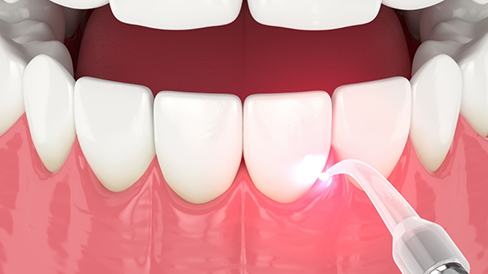 Illustration of a topical antibiotic being applied to the gums