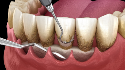 Illustration of the gum tissue being pulled back by dental instruments