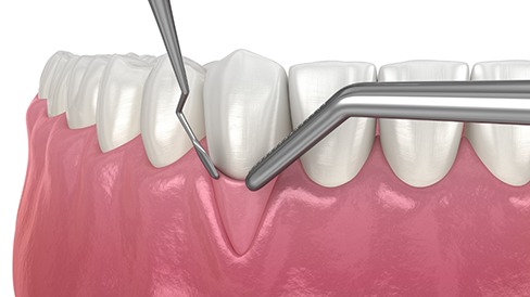 Illustration of soft tissue being grafted onto receding gums