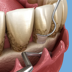 Illustration of dental scalers clearing the tooth roots