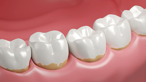 Illustration of a row of teeth with some tartar buildup