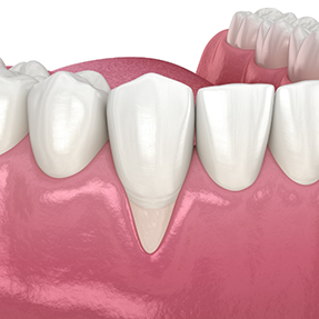 Illustration of a tooth with receding gums in front of it