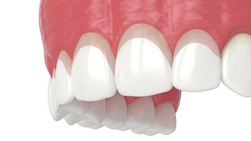 Illustrated row of teeth before and after crown lengthening