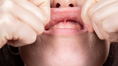 Person stretching out their upper lip