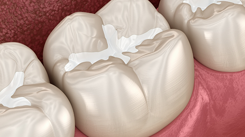 Illustration of a tooth with a white filling