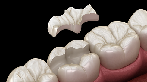 Illustration of a dental inlay restoring a broken tooth