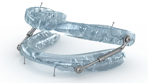 Light gray oral appliance