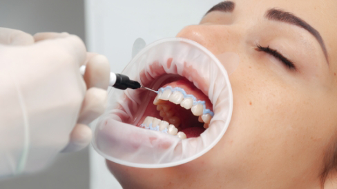 Dental patient getting professional teeth whitening