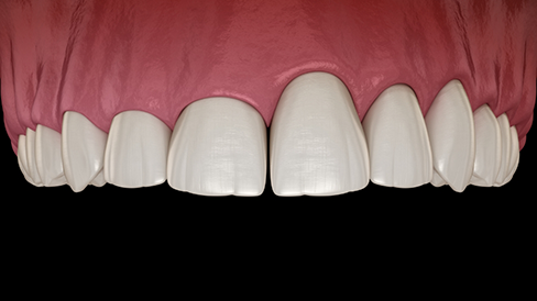 Illustration of an uneven gumline