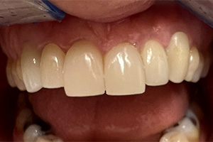 implants crowns case after