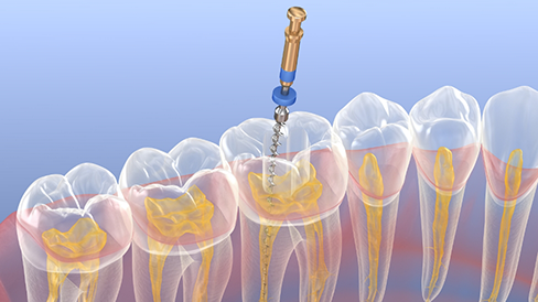 Illustration of a thin dental instrument treating the inside of a tooth