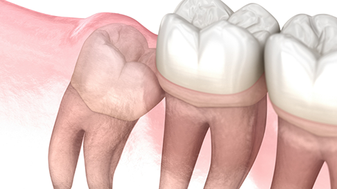 Illustration of an impacted wisdom tooth pressing against the adjacent tooth