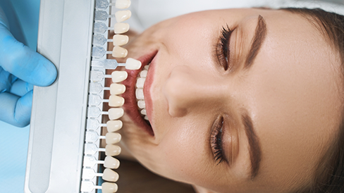 Dentist holding a veneer shade guide in front of a patient's smile