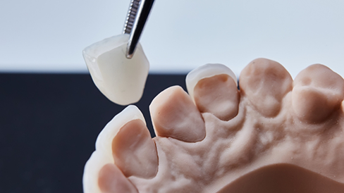 Tweezers placing a veneer over a model of a tooth