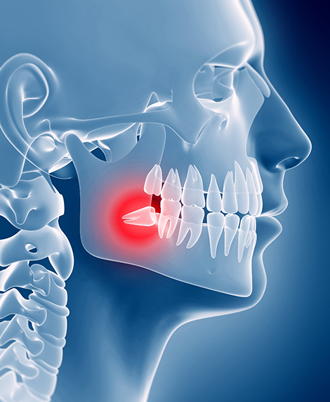 Illustrated x ray of a person with an impacted wisdom tooth