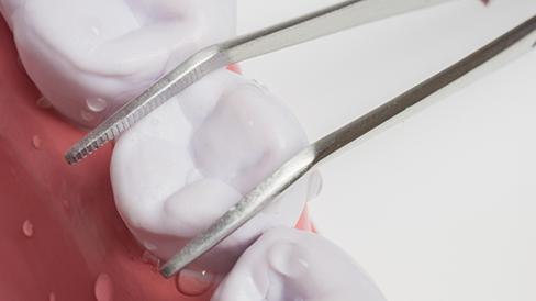 Tweezers removing a model of a tooth