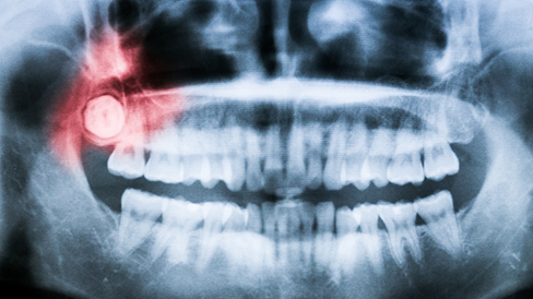 X ray of teeth with an impacted wisdom tooth highlighted in red