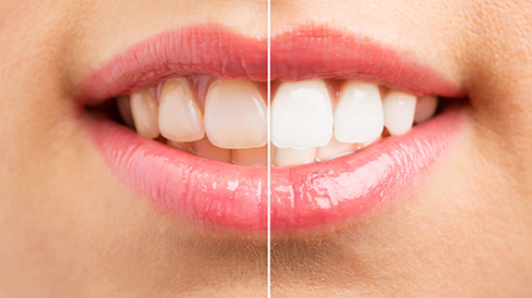 Smile before and after teeth whitening